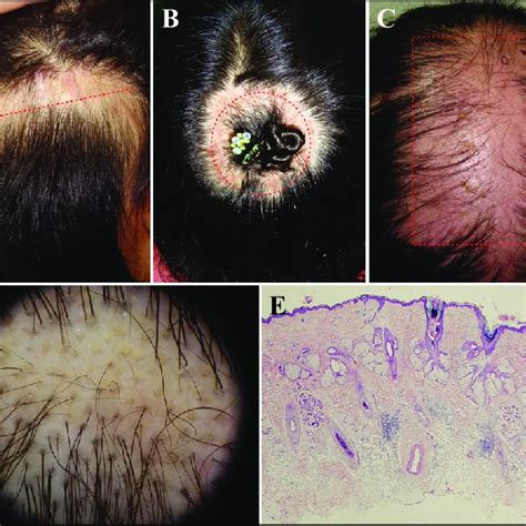 Clinical Characteristics A B Annular Alopecic Patches On Scalp C