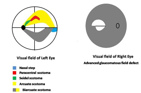 Humphrey Visual Field Treatment Management Point Of Care