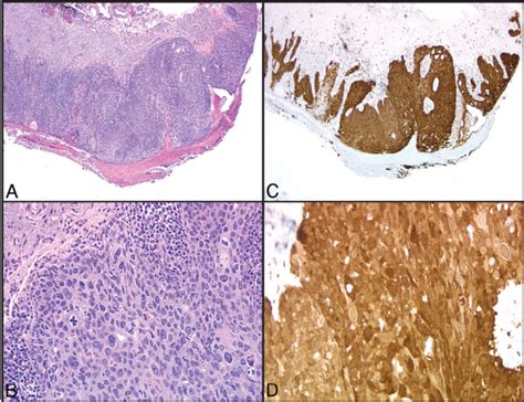 Squamous Cell Carcinoma In Situ Histology