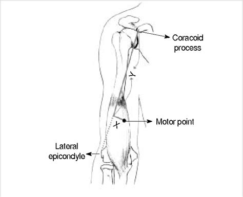 Figure From Anatomic Motor Point Localization Of The Biceps Brachii