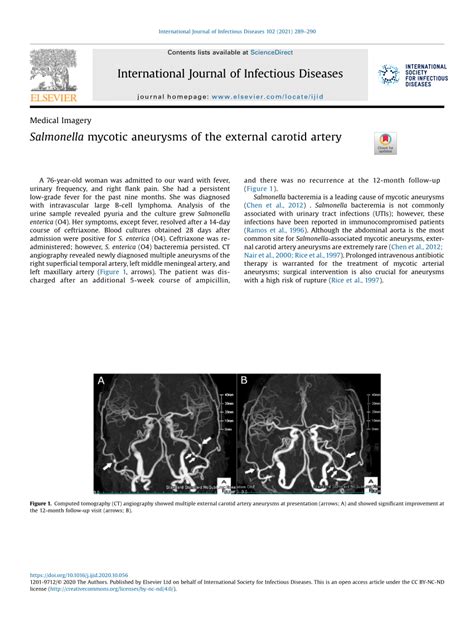 Pdf Salmonella Mycotic Aneurysms Of The External Carotid Artery