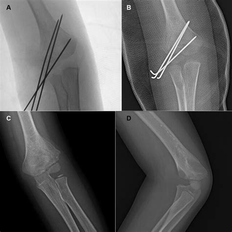 Typical X Ray Of Type Ii Degree Ii Fractures Ap A Images Showing Download Scientific Diagram