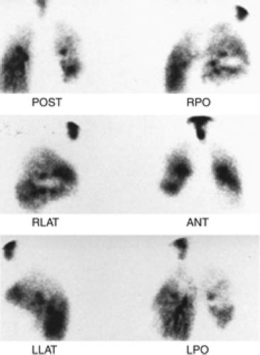 Radionuclide Pulmonary Imaging | Radiology Key