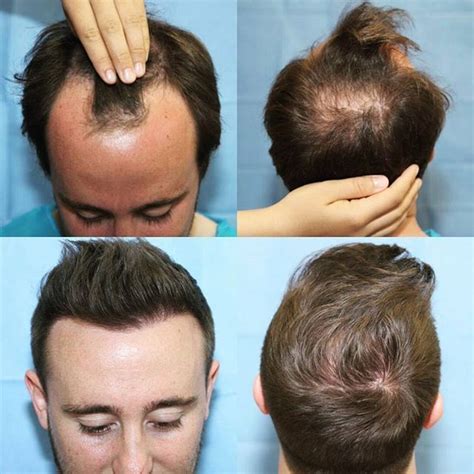 Hair Transplant Before After Photos