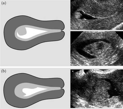 Terms Definitions And Measurements To Describe The Sonographic