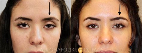 Ptosis Repair Before And After Dr Ali Ghafouri