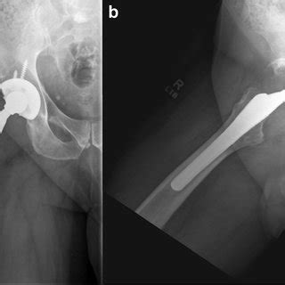 Anteroposterior AP A And Lateral Hip B Radiographs Demonstrating