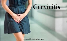 Cervicitis - Definition, Types, Causes, and Treatment.