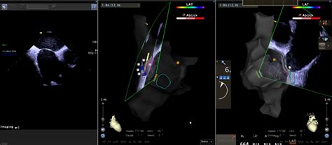 Zerofluoroscopy Transseptal Puncture Guided By Right Atrial