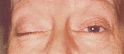 Ptosis Causes Presentation And Management Springerlink