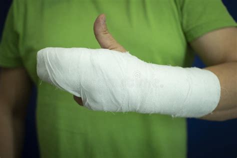 A Man With A Cast On His Armman`s Hand In Bandages After Surgery Stock