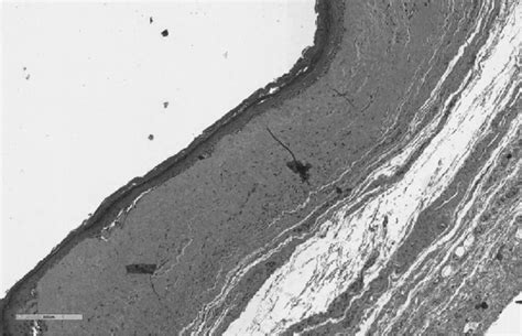 -Pre-treatment Histology (×10 magnification). Hyperkeratosis, dermal... | Download Scientific ...