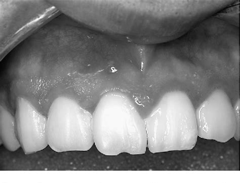 Figure 1 From Microscopic Endodontics In Infected Root Canal With Calcified Structure A Case