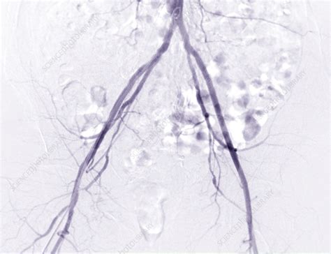 Femoral artery, CT scan - Stock Image - F037/7158 - Science Photo Library