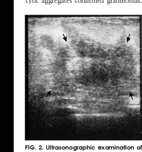 Figure From Granulomatous Mastitis Including Breast Tuberculosis And