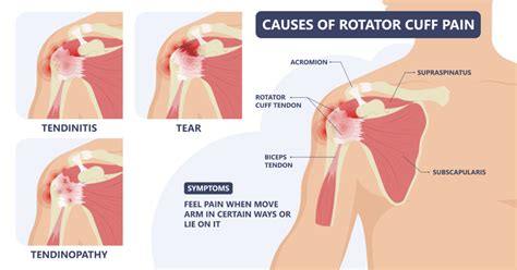 Rotator Cuff Tear | Signs & Symptoms | Jeremy Burnham, MD