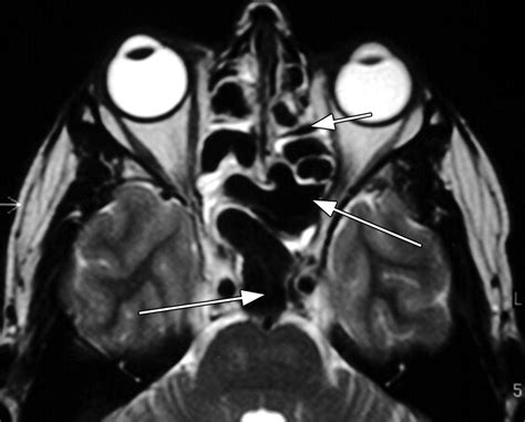 Imaging Features Of Invasive And Noninvasive Fungal Sinusitis A Review