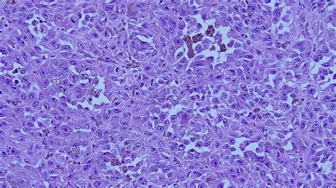 How well do you know Mucosal Melanoma