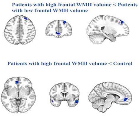 Frontiers Frontal White Matter Hyperintensities Effect On Default