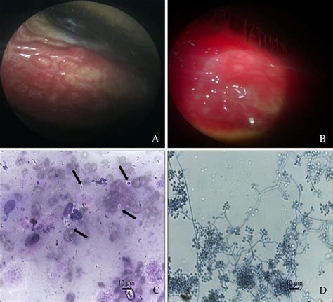 Photograph Of The Lower Palpebral Conjunctiva Showing A Granulomatous