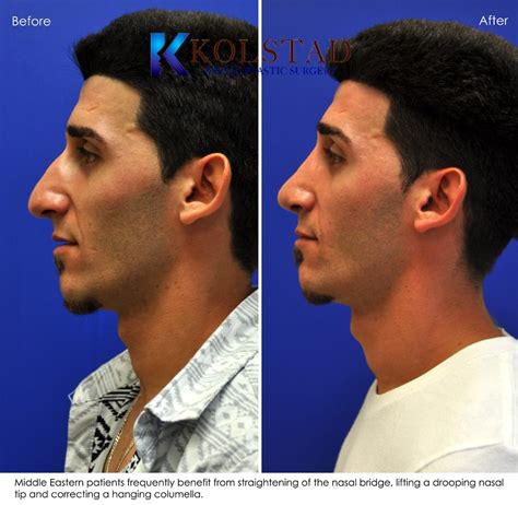 Nasal Tip Ptosis Nose Job For Men Before And After Gallery 19 Dr