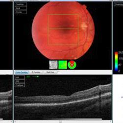 Oct Scan Of One Of The Cases In The C F Group Preoperative And