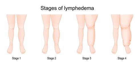 Understanding Lymphedema Causes Symptoms And Management Health