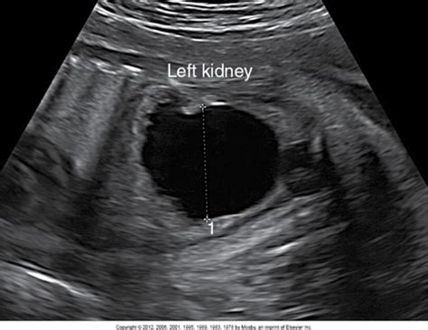 Ch 58 Amniotic Fluid Pathophysiology From Pp Flashcards Quizlet