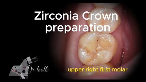 Zirconia Crown Preparation Of Upper First Molar