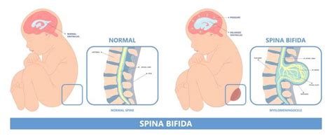 Sacral Dimples In Newborn Symptoms Causes And Treatment