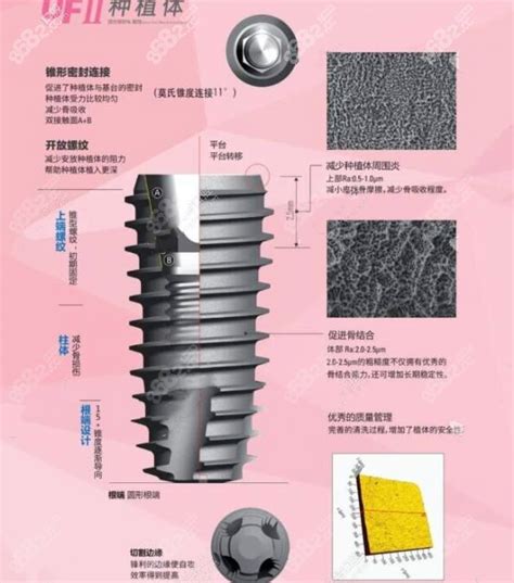 韩国dio种植体uf型号一览原来韩国uf种植体是dio中的一个型号种植牙 8682整形网