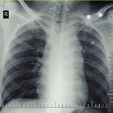 Antero Posterior Chest Radiograph The Axial Sections Of Thoracic