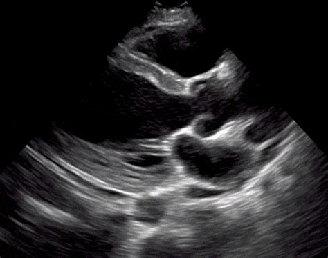 Echocardiogram Heart Ultrasound Vs