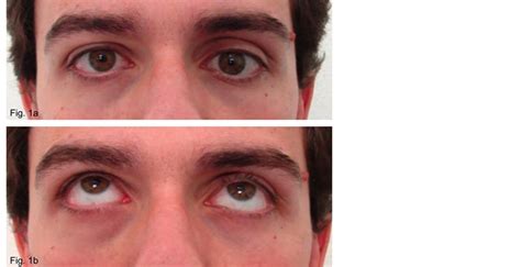 Silent Sinus Syndrome Clinical Findings And Differential Diagnosis