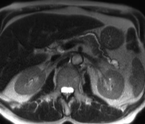 Mr Imaging Of Cystic Lesions Of The Pancreas Radiographics