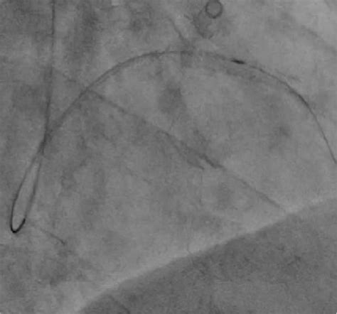 Angioscopy Procedure Right Anterior Oblique Cranial View Fluoroscopy