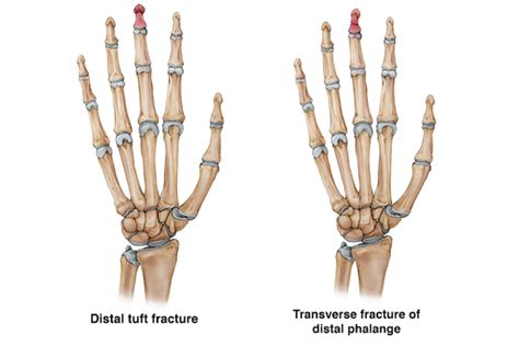 Finger fractures