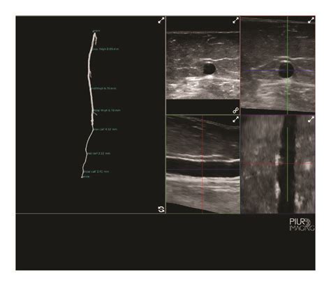 The great saphenous vein as seen with a 3D tomographic ultrasound ...