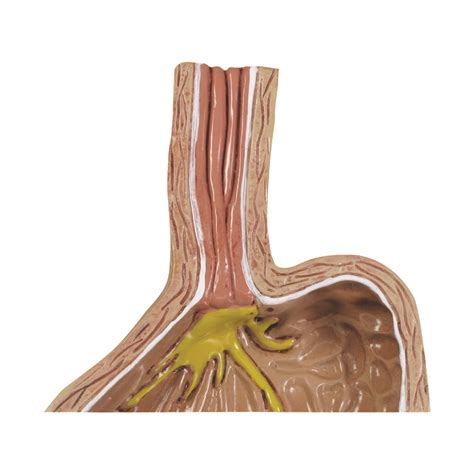 Teilig Mit Gerd Gastro Sophageale Refluxkrankheit Anatomische Modelle