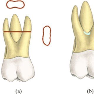 Maxillary First Molar Root Canal Anatomy