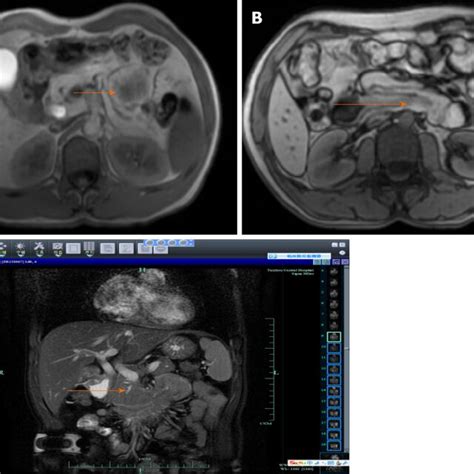 Magnetic Resonance Cholangiopancreatography A Magnetic Resonance Download Scientific Diagram