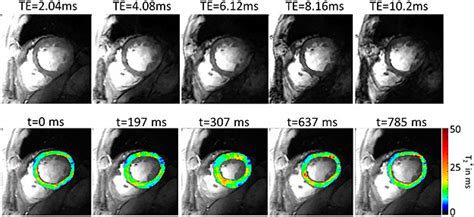 Example Of Myocardial T2 Mapping At 70 T Top T2 Weighted Short