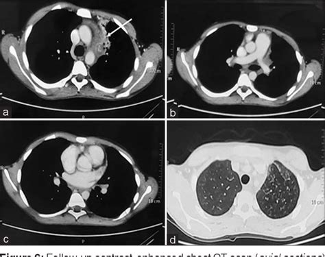 Figure 6 From A Rare Case Of Isoniazid Mono Resistant Tuberculosis Presenting As Cardiac