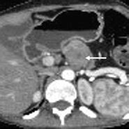 Pancreatic ductal adenocarcinomas. Axial ( ) and precontrast ( )... | Download Scientific Diagram