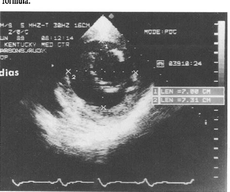 Figure 3 From Value And Limitations Of Transesophageal Echocardiography