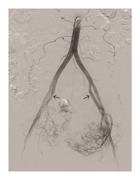 Pelvic Angiogram—early Arterial Phase Both Internal Iliac Arteries Download Scientific Diagram