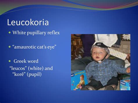 Ppt White Pupillary Reflex In Children Powerpoint Presentation Free