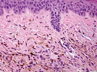 Ochronosis Histology