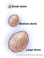 Conditions - Bladder Stones - Brown Urology Brown Physicians, Inc