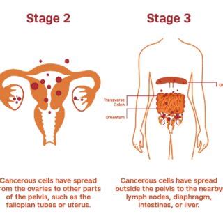 Ovarian Cancer Stages (Weill Cornell Medicine) | Download Scientific ...